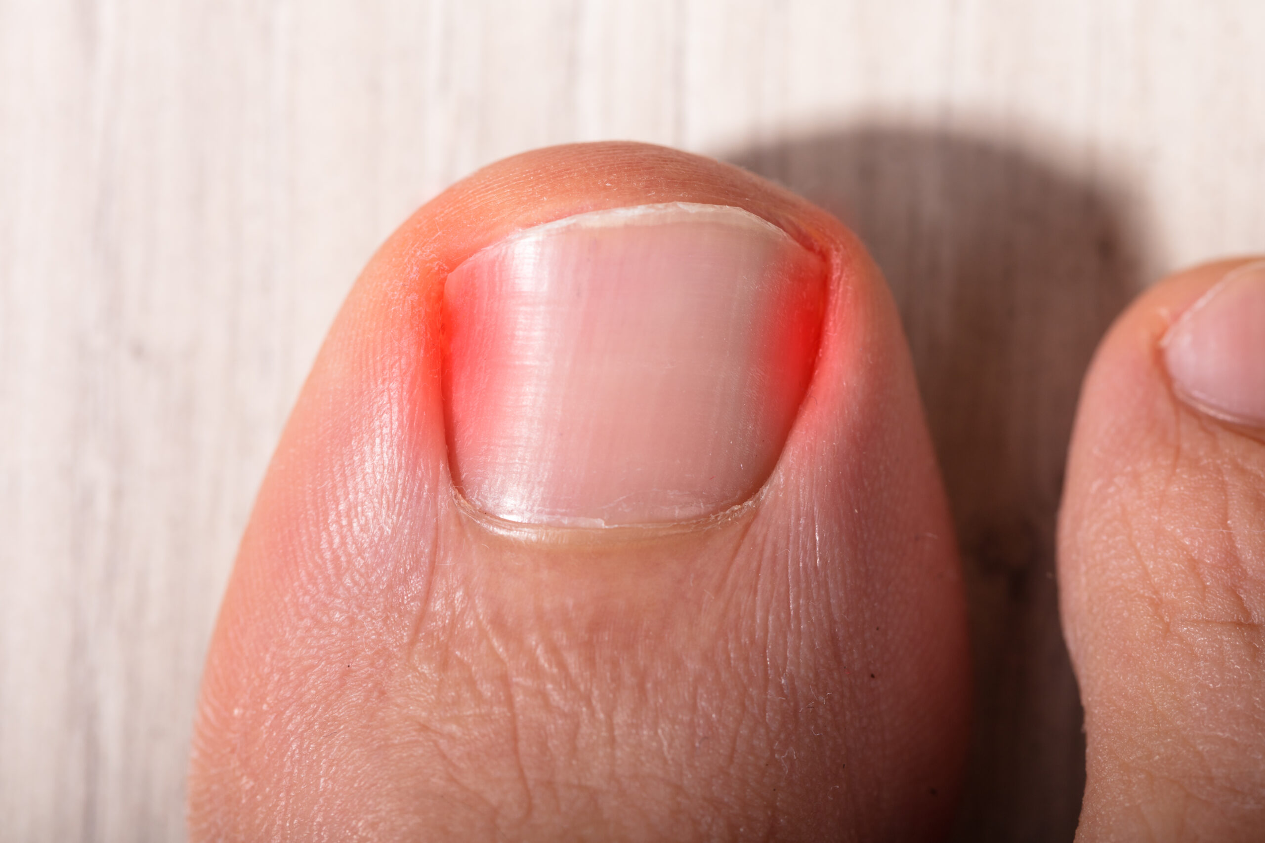 How to get rid of ingrown nails