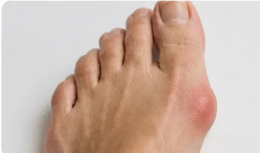 Bunion and bone spur treatment in Denton, TX