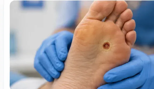 Diabetic foot wound care in Denton, TX