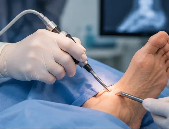Minimally invasive foot surgery in Denton, TX