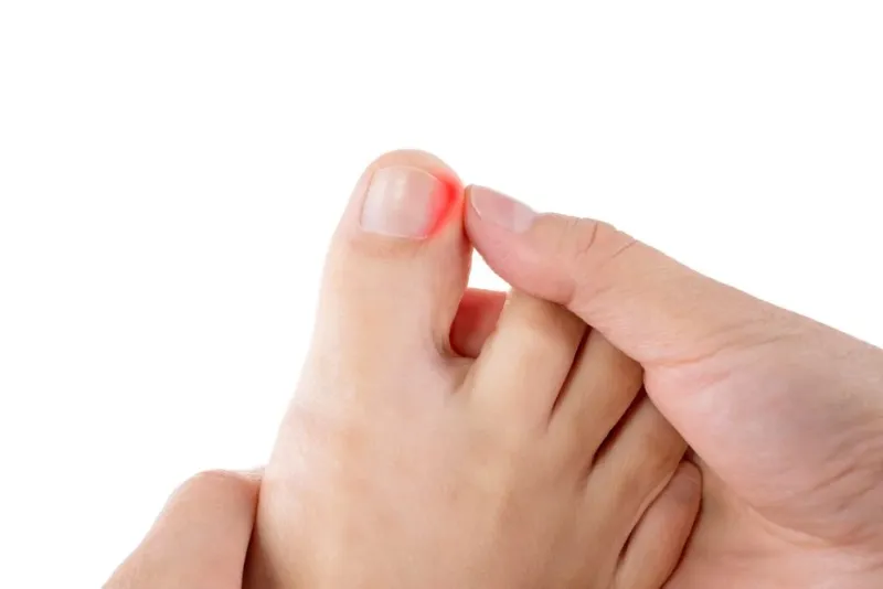 Ingrown toenail, nail fungus and skin treatment